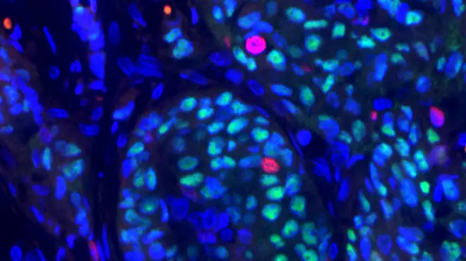 Painted cellular image of breast cancer Painted cellular image of breast cancer