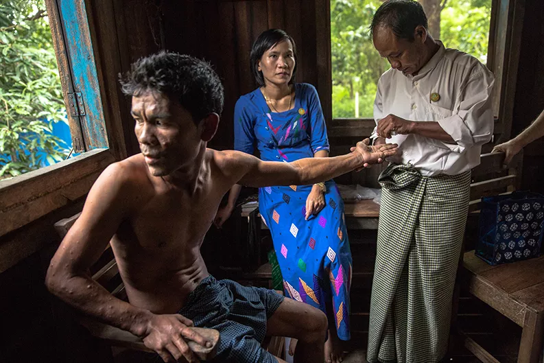 Ein Mann unterzieht sich in Myanmar einer Untersuchung auf Lepra