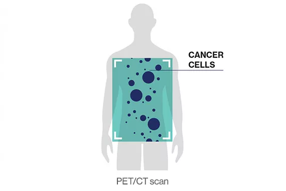 Precision based approach to spot cancer cells using PET/CT scan