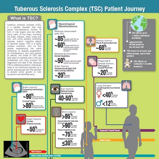 Tuberous Sclerosis Complex Patient Journey Infographic